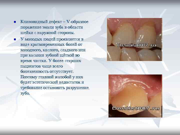 n Клиновидный дефект – V-образное поражение эмали зуба в области шейки с наружной n Клиновидный дефект – V-образное поражение эмали зуба в области шейки с наружной