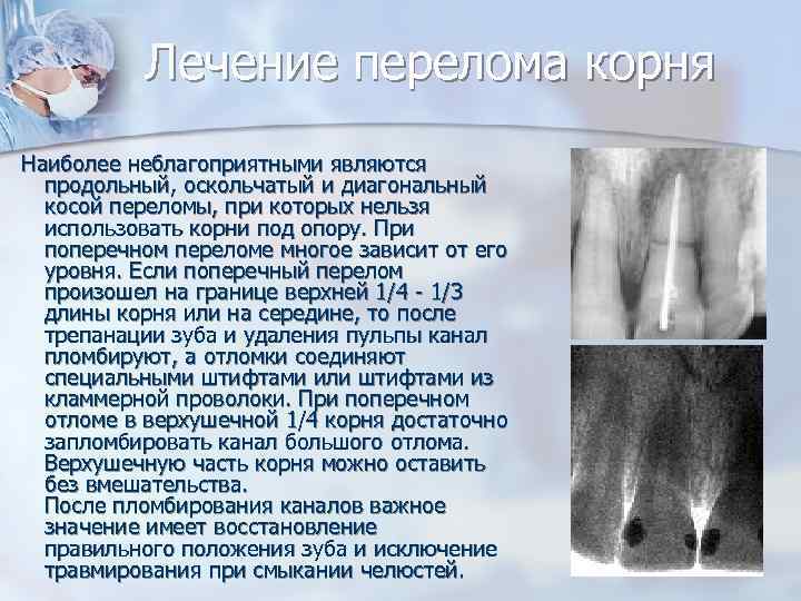   Лечение перелома корня  Наиболее неблагоприятными являются продольный, оскольчатый и диагональный косой