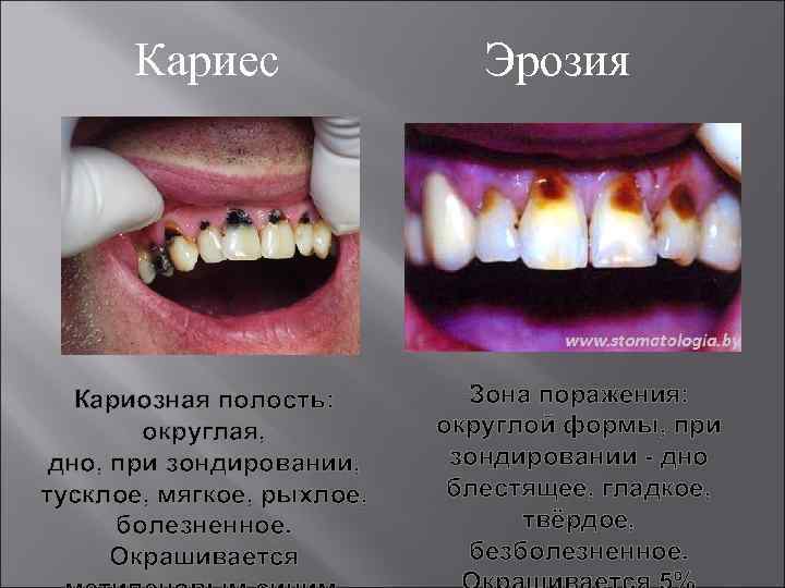  Кариес   Эрозия  Кариозная полость:   Зона поражения:  