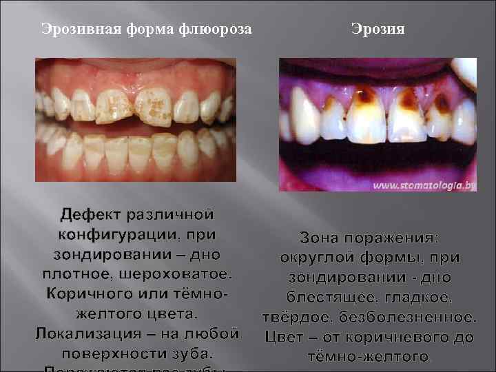 Эрозивная форма флюороза  Эрозия  Дефект различной  конфигурации, при  Зона поражения: