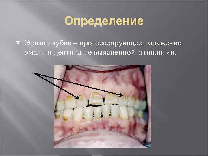    Определение Эрозии зубов – прогрессирующее поражение эмали и дентина не выясненной