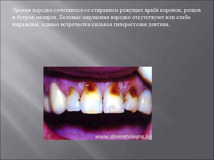 Эрозии нередко сочетаются со стиранием режущих краёв коронок, резцов и бугров маляров. Болевые ощущения