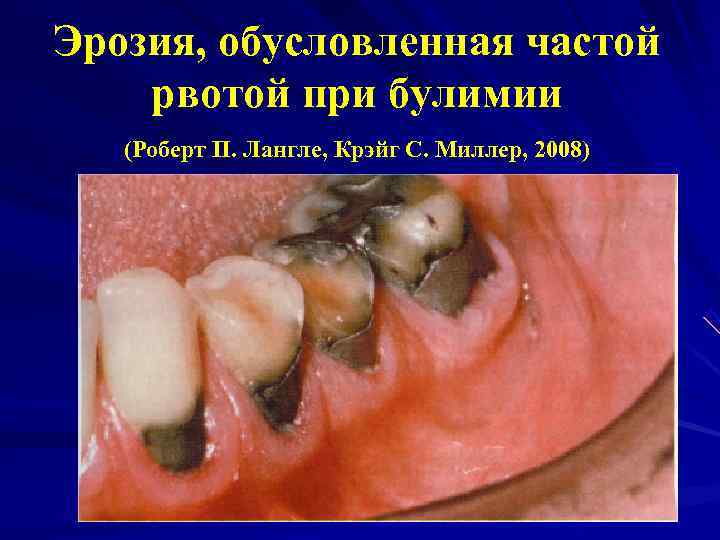 Эрозия, обусловленная частой рвотой при булимии  (Роберт П. Лангле, Крэйг С. Миллер, 2008)