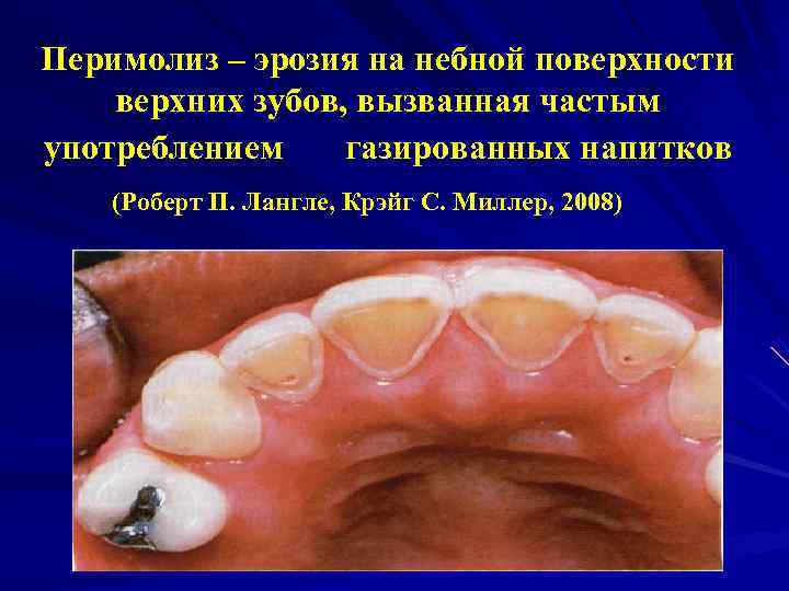 Перимолиз – эрозия на небной поверхности верхних зубов, вызванная частым употреблением газированных напитков (Роберт