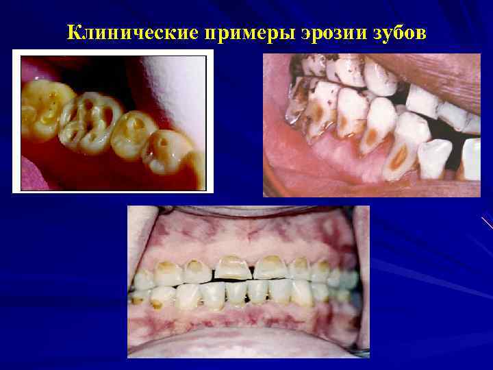 Клинические примеры эрозии зубов 