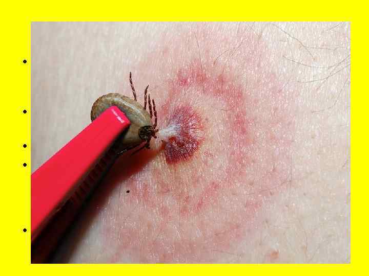    Удаление клеща • Если планируете сдать клеща на анализ, то 