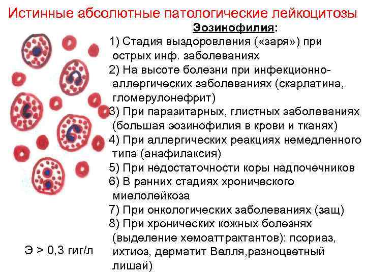 Истинные абсолютные патологические лейкоцитозы       Эозинофилия:   