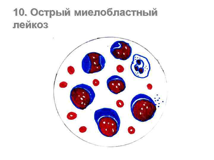 10. Острый миелобластный лейкоз 