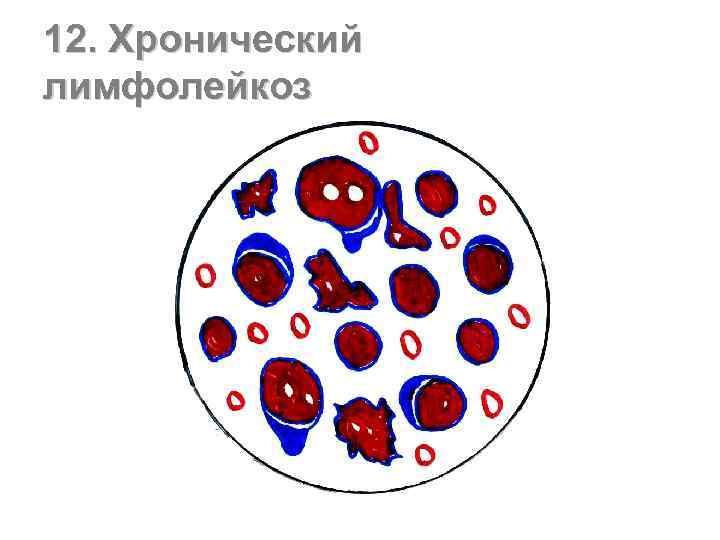 12. Хронический лимфолейкоз 
