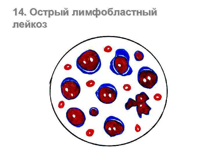 14. Острый лимфобластный лейкоз 