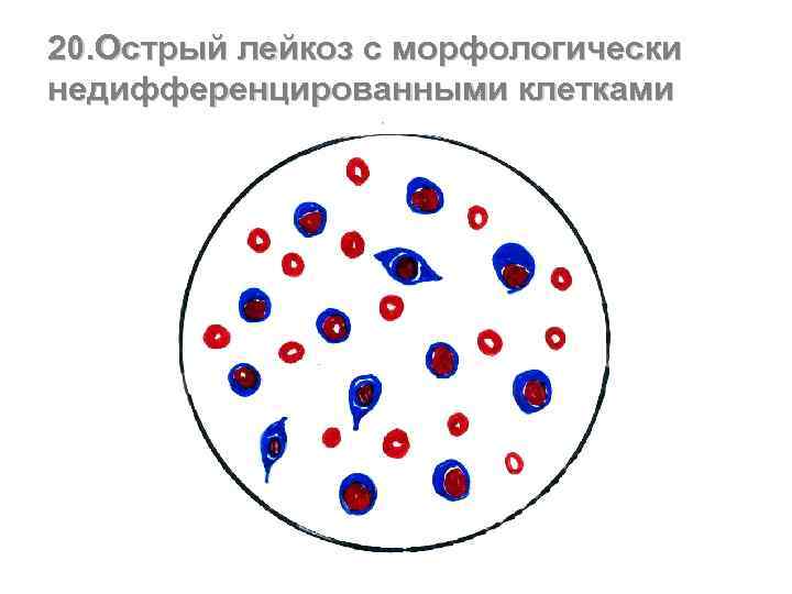 20. Острый лейкоз с морфологически недифференцированными клетками 