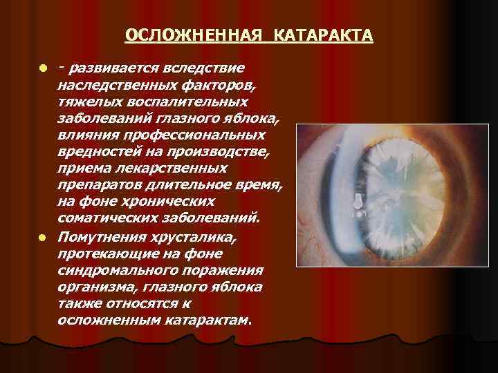 ОСЛОЖНЕННАЯ КАТАРАКТА l l - развивается вследствие наследственных факторов, тяжелых воспалительных заболеваний глазного яблока,