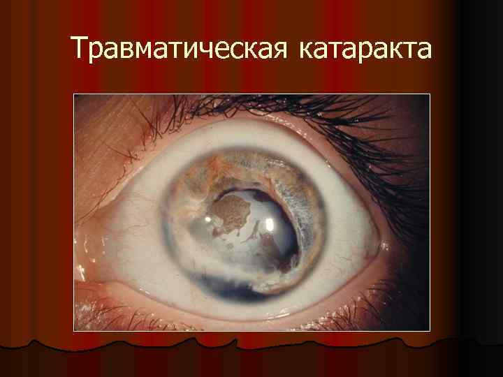 Травматическая катаракта 