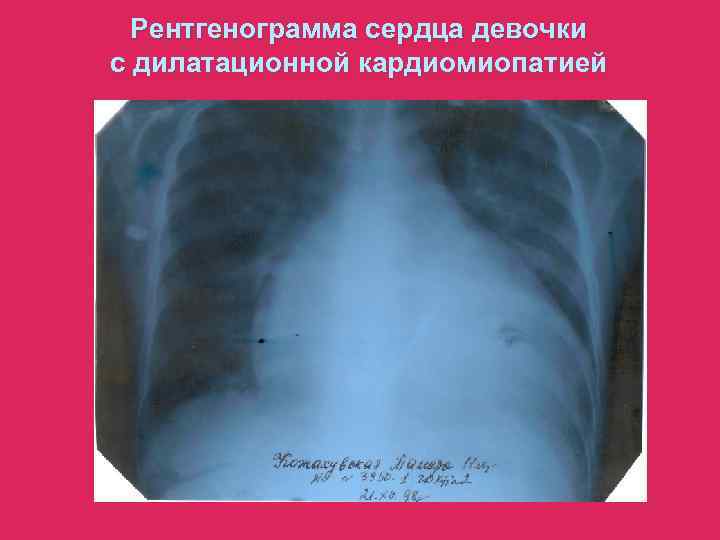  Рентгенограмма сердца девочки с дилатационной кардиомиопатией 