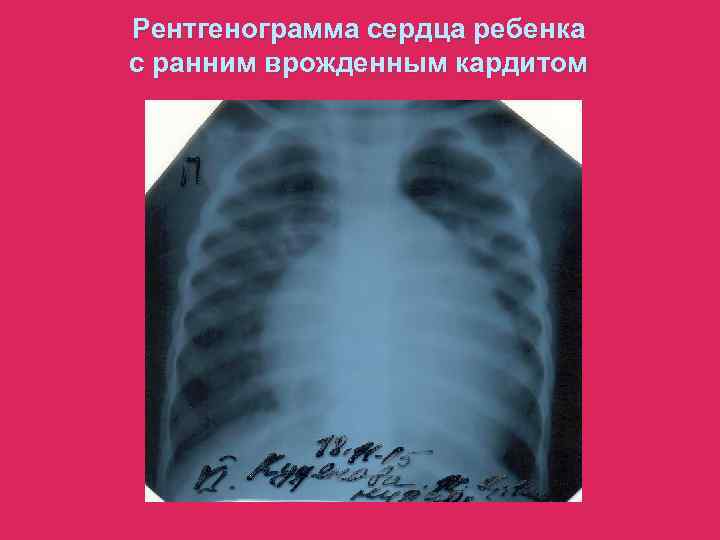 Рентгенограмма сердца ребенка с ранним врожденным кардитом 