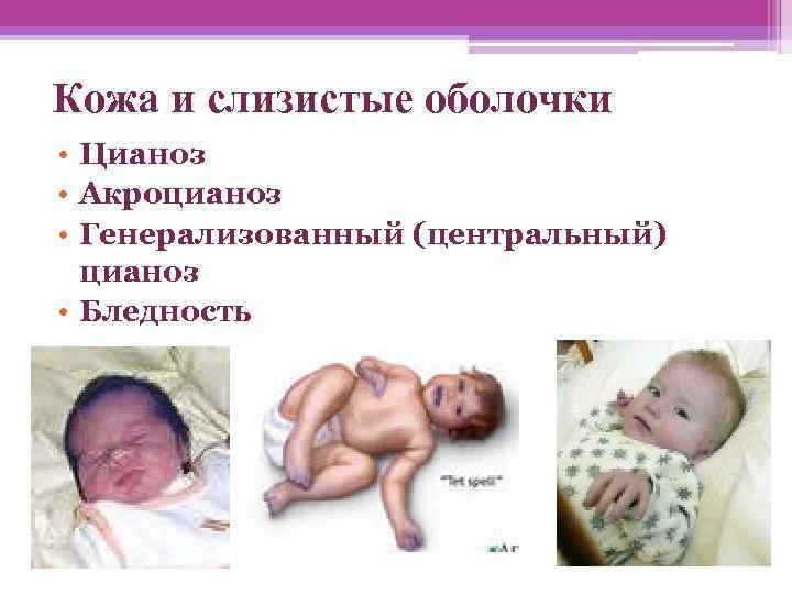 Кожа и слизистые оболочки • Цианоз • Акроцианоз • Генерализованный (центральный)  цианоз •