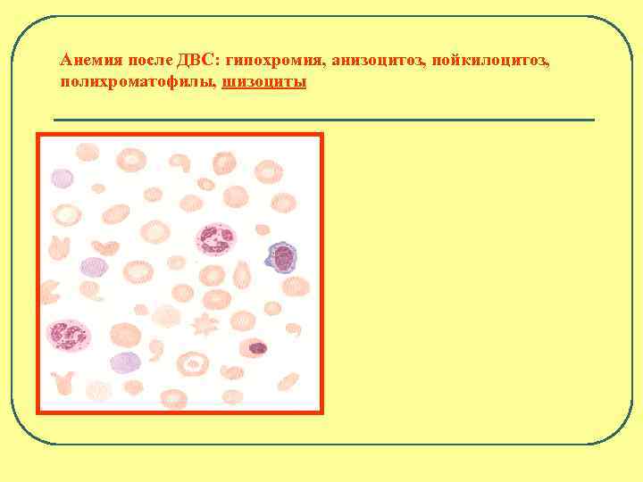 Анемия после ДВС: гипохромия, анизоцитоз, пойкилоцитоз, полихроматофилы, шизоциты 