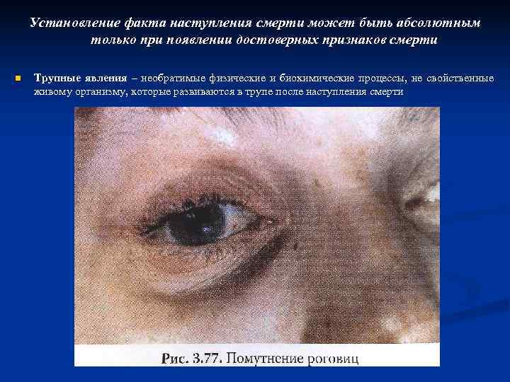   Установление факта наступления смерти может быть абсолютным   только при появлении