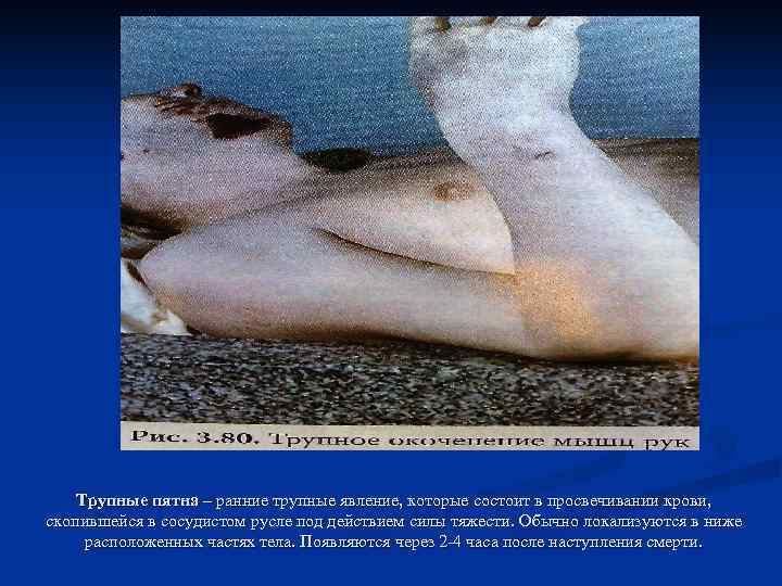   Трупные пятна – ранние трупные явление, которые состоит в просвечивании крови, скопившейся