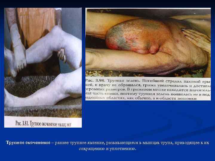 Трупное окоченение – раннее трупное явление, развивающиеся в мышцах трупа, приводящее к их 