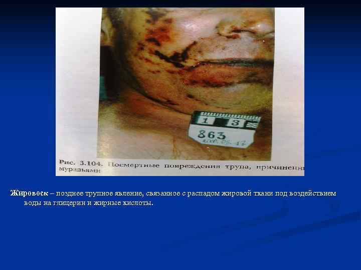 Жировоск – позднее трупное явление, связанное с распадом жировой ткани под воздействием  воды