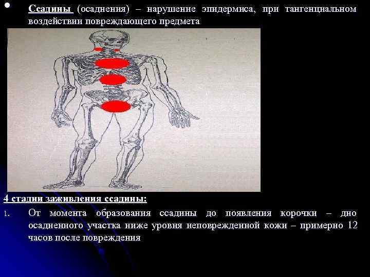  •  Ссадины (осаднения) – нарушение эпидермиса, при тангенциальном воздействии повреждающего предмета 4