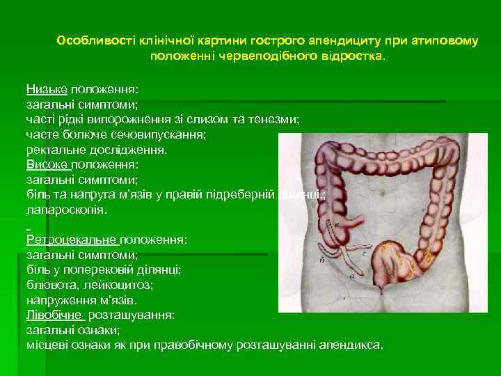  Особливості клінічної картини гострого апендициту при атиповому    положенні червеподібного відростка.