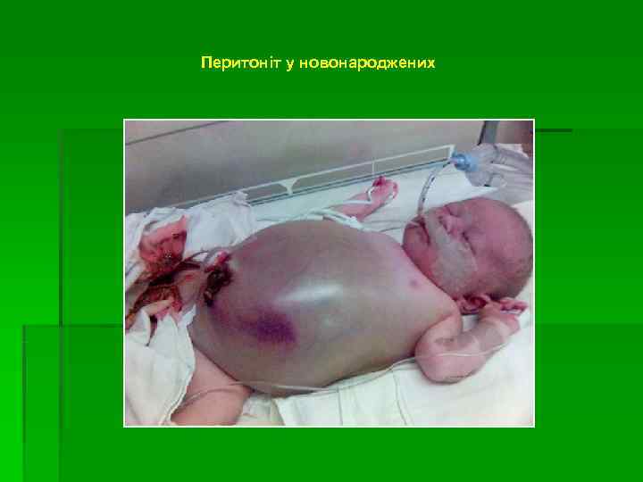 Перитоніт у новонароджених 