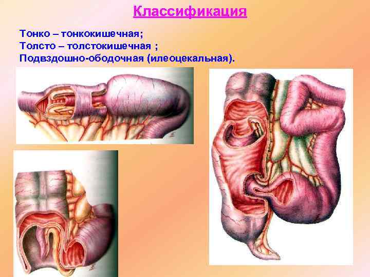     Классификация Тонко – тонкокишечная; Толсто – толстокишечная ; Подвздошно-ободочная (илеоцекальная).