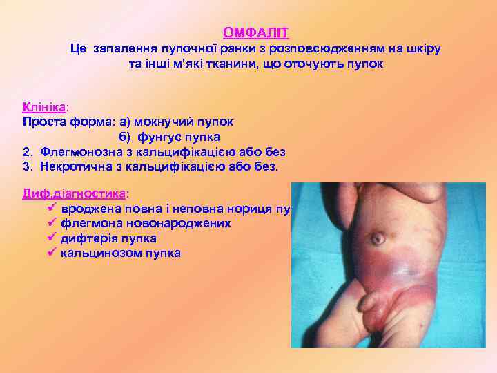      ОМФАЛІТ  Це запалення пупочної ранки з розповсюдженням на