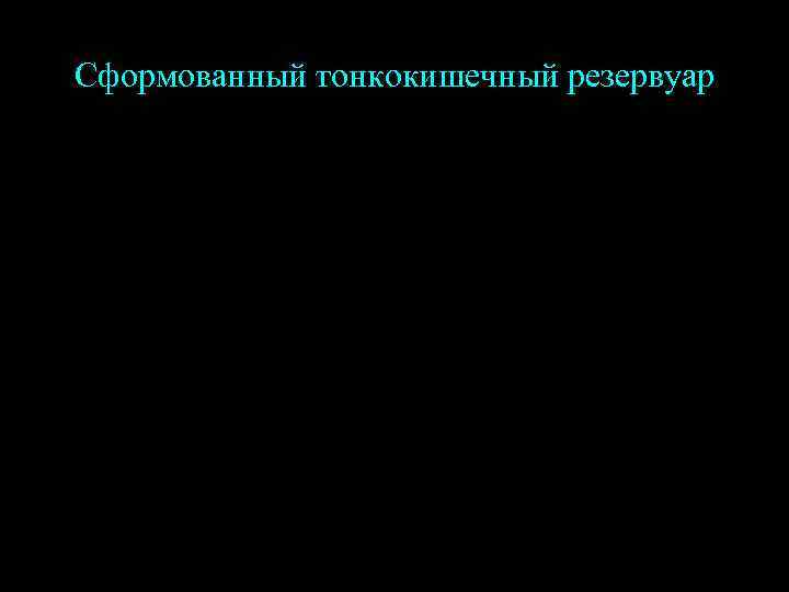 Сформованный тонкокишечный резервуар 