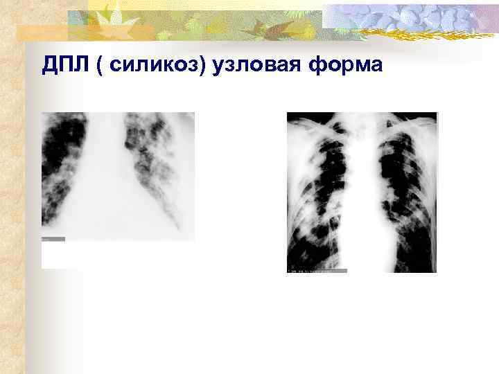 ДПЛ ( силикоз) узловая форма 