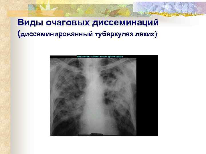Виды очаговых диссеминаций (диссеминированный туберкулез леких) 