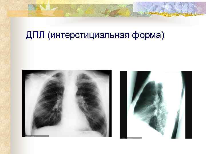 ДПЛ (интерстициальная форма) 