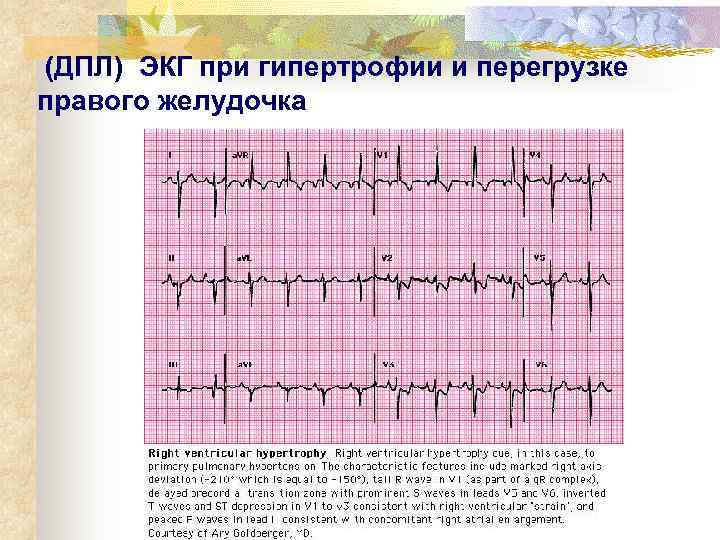  (ДПЛ) ЭКГ при гипертрофии и перегрузке правого желудочка 