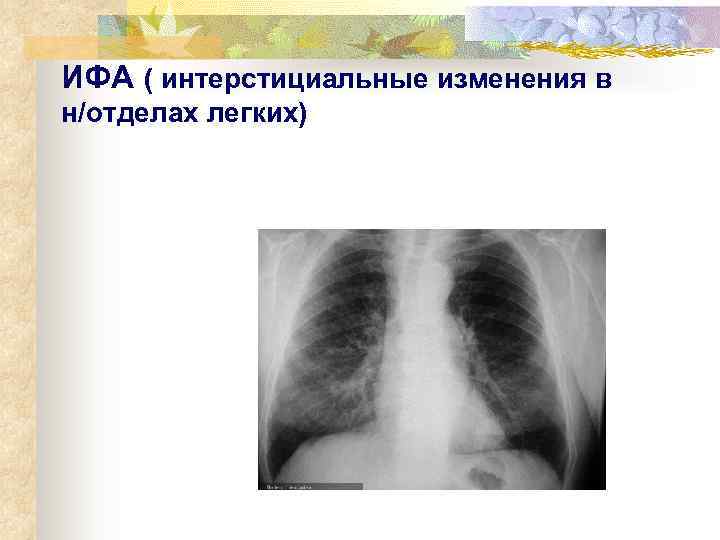 ИФА ( интерстициальные изменения в н/отделах легких) 