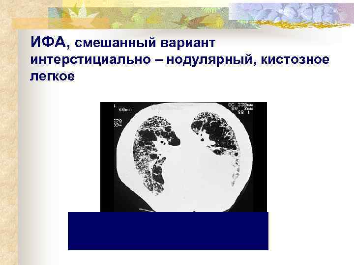 ИФА, смешанный вариант интерстициально – нодулярный, кистозное легкое 
