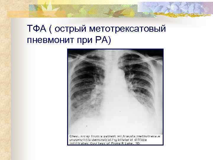 ТФА ( острый метотрексатовый пневмонит при РА) 