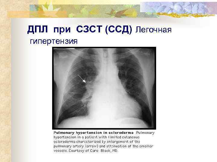 ДПЛ при СЗСТ (ССД) Легочная гипертензия 