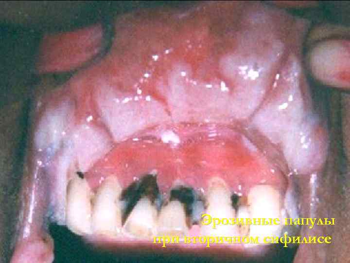 Эрозивные папулы при вторичном сифилисе 