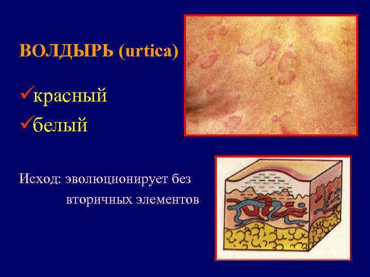 ВОЛДЫРЬ (urtica) üкрасный üбелый Исход: эволюционирует без  вторичных элементов 