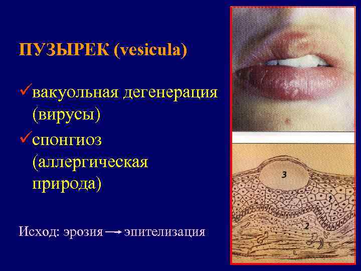ПУЗЫРЕК (vesicula) üвакуольная дегенерация (вирусы) üспонгиоз (аллергическая природа) Исход: эрозия  эпителизация 
