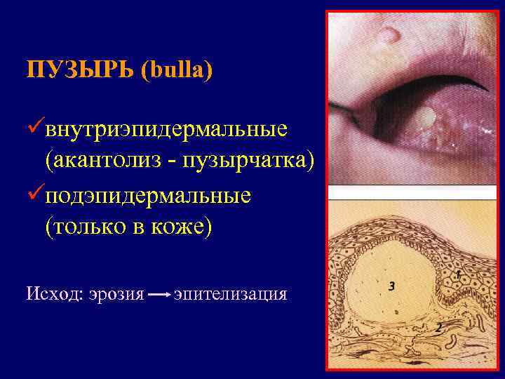 ПУЗЫРЬ (bulla) üвнутриэпидермальные (акантолиз - пузырчатка) üподэпидермальные (только в коже) Исход: эрозия  эпителизация