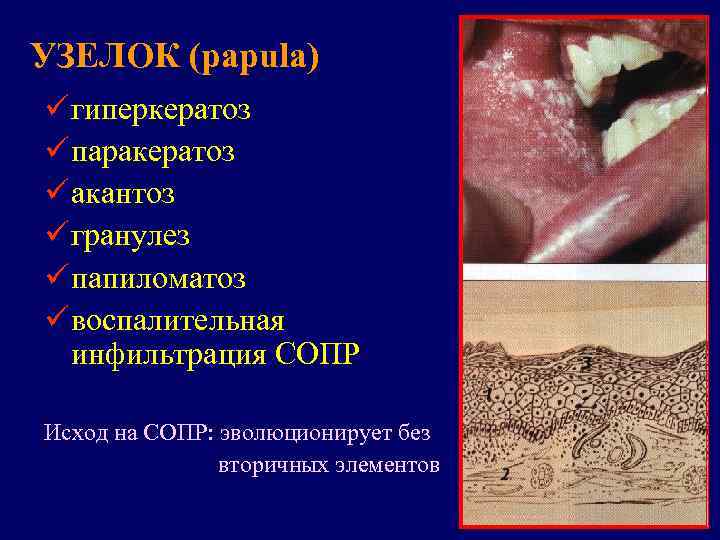 УЗЕЛОК (papula) ü гиперкератоз ü паракератоз ü акантоз ü гранулез ü папиломатоз ü воспалительная