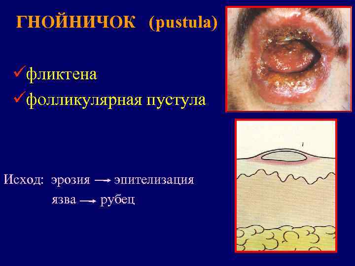  ГНОЙНИЧОК (pustula)  üфликтена üфолликулярная пустула  Исход: эрозия  эпителизация  язва