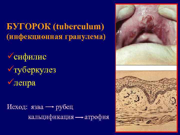 БУГОРОК (tuberculum) (инфекционная гранулема) üсифилис üтуберкулез üлепра Исход: язва  рубец  кальцификация 