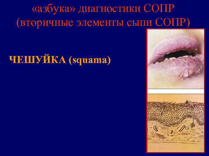  «азбука» диагностики СОПР (вторичные элементы сыпи СОПР)  ЧЕШУЙКА (squama) 