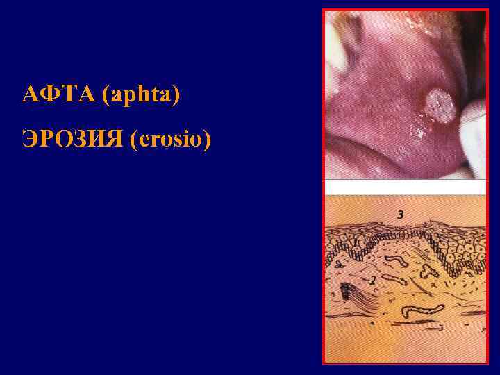 АФТА (aphta) ЭРОЗИЯ (erosio) 