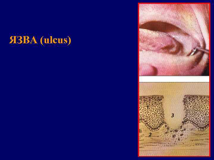 ЯЗВА (ulcus) 