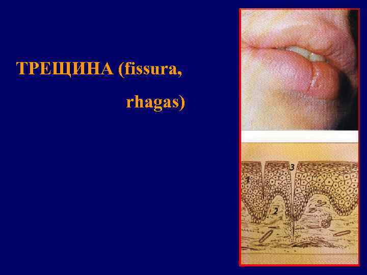 ТРЕЩИНА (fissura,   rhagas) 